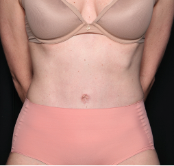 Tummy Tuck Before & After Patient #34348